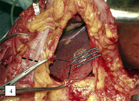 Пересечение ободочной кишки в проксимальном направлении
