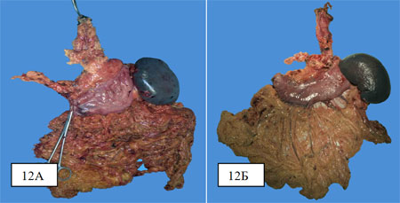 Препарат «en bloc» после надпривратниковой гастрэктомии с резекцией грудного отдела пищевода из доступа по I.Lewis. Препарат после экстирпации желудка с резекцией грудного отдела пищевода из доступа по I.Lewis