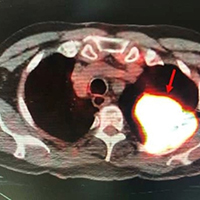 Огнестрельное ранение полувековой давности связали с развитием рака легкого у пожилого американца