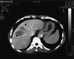 Перед HIFU. На компьютерной томограмме, выполненной в венозную фазу, визуализируется крупная опухоль (стрелки), расположенная между средней и правой печеночной веной в восьмом сегменте