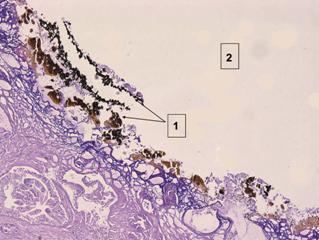 Микроскопическая картина ткани предстательной железы в зоне воздействия ВЛК