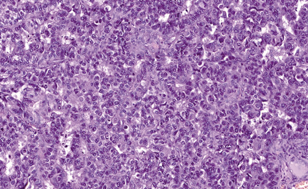 Морфологическая картина метастаза протокового рака грудной железы в головном мозге