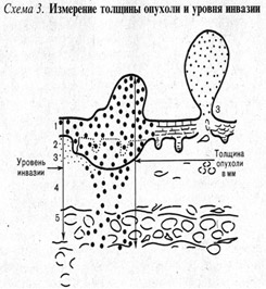 Схема определения уровня инвазии по Кларку