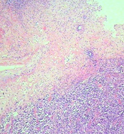 Гистологическая картина изъязвления